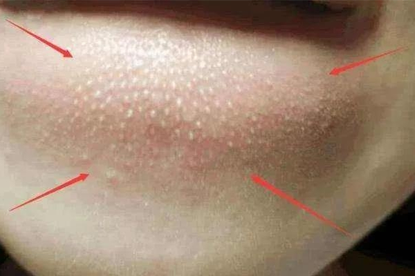 閉口粉刺怎么可以有效去除 閉口粉刺是什么原因引起的 閉口粉刺怎么可以有效去除 閉口粉刺是什么原因引起的