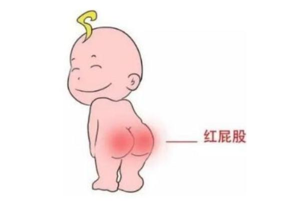 寶寶紅屁股會疼嗎 寶寶紅屁股會影響什么 寶寶紅屁股會疼嗎 寶寶紅屁股會影響什么