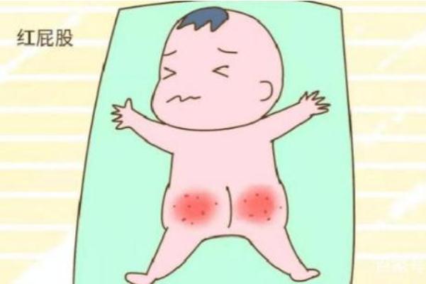 寶寶紅屁股怎么護(hù)理 寶寶紅屁股什么原因?qū)е? alt=