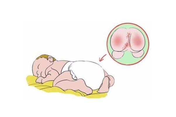 寶寶紅屁股會疼嗎 寶寶紅屁股會影響什么 寶寶紅屁股會疼嗎 寶寶紅屁股會影響什么