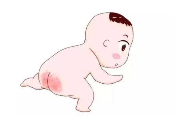寶寶紅屁股怎么護(hù)理 寶寶紅屁股什么原因?qū)е? alt=