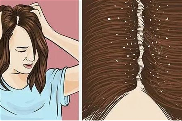 去頭屑用什么洗發(fā)水好 頭屑用什么方法洗掉 去頭屑用什么洗發(fā)水好 頭屑用什么方法洗掉