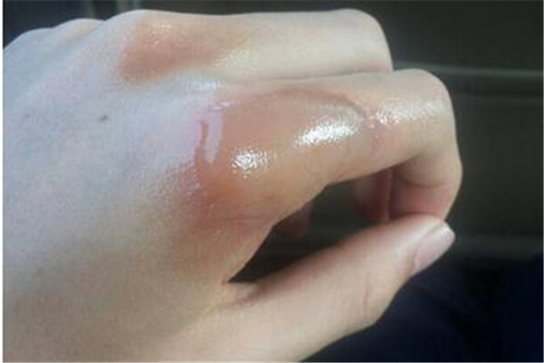 凍瘡快好了是什么樣子 凍瘡好了會跟以前的手一樣嗎 凍瘡快好了是什么樣子 凍瘡好了會跟以前的手一樣嗎