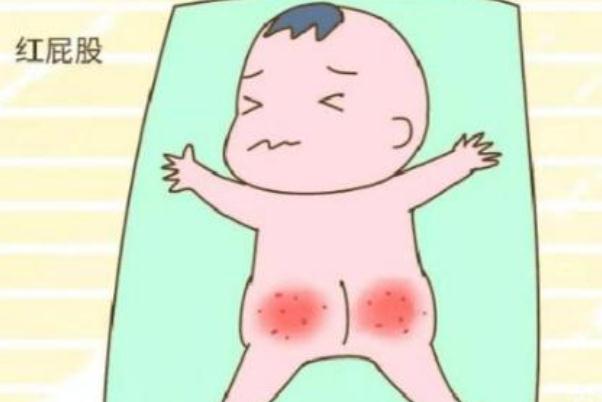 寶寶紅屁股是不是尿不濕造成 寶寶紅屁股是過敏癥狀嗎 寶寶紅屁股是不是尿不濕造成 寶寶紅屁股是過敏癥狀嗎