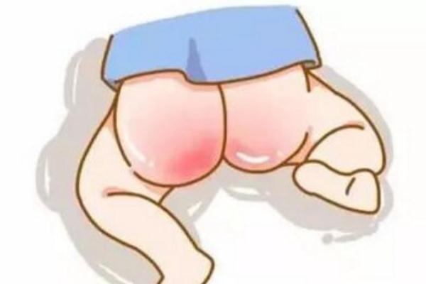 寶寶紅屁股擦什么好得快 寶寶紅屁股破了怎么處理 寶寶紅屁股擦什么好得快 寶寶紅屁股破了怎么處理