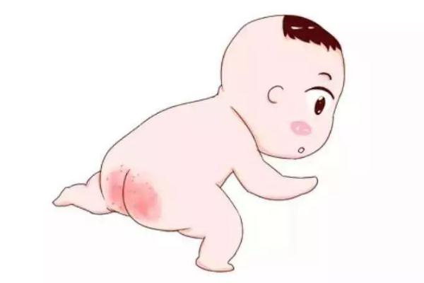 寶寶紅屁股是不是尿不濕造成 寶寶紅屁股是過敏癥狀嗎 寶寶紅屁股是不是尿不濕造成 寶寶紅屁股是過敏癥狀嗎