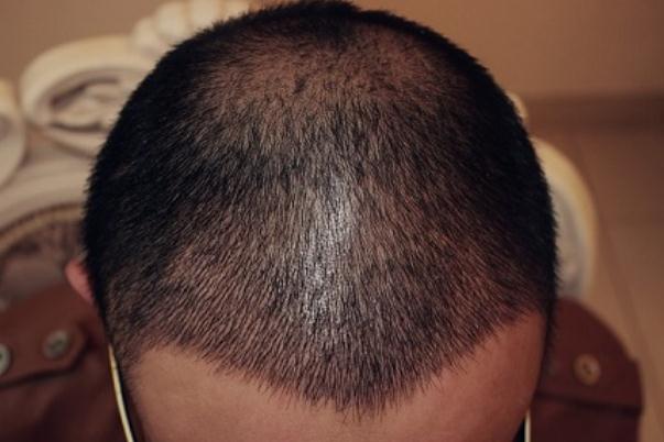 植發(fā)對身體健康有影響嗎 植發(fā)對頭皮有傷害嗎 植發(fā)對身體健康有影響嗎 植發(fā)對頭皮有傷害嗎