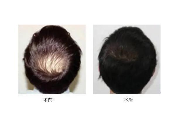 植發(fā)會(huì)自己生長(zhǎng)嗎 植發(fā)會(huì)失敗嗎 植發(fā)會(huì)自己生長(zhǎng)嗎 植發(fā)會(huì)失敗嗎