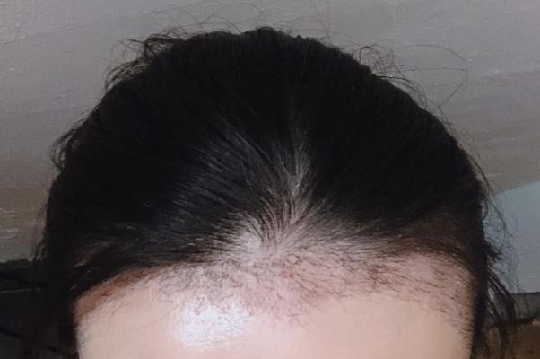 植發(fā)可以用別人的毛囊嗎 植發(fā)可以保持多久時間 植發(fā)可以用別人的毛囊嗎 植發(fā)可以保持多久時間