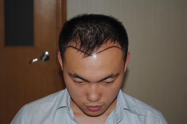 植發(fā)可以用別人的毛囊嗎 植發(fā)可以保持多久時間 植發(fā)可以用別人的毛囊嗎 植發(fā)可以保持多久時間