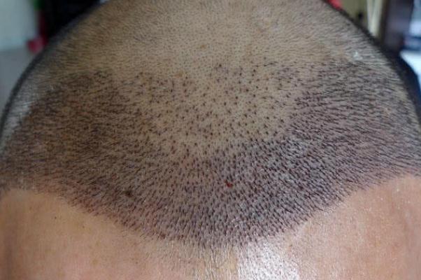 植發(fā)要多少錢一般 植發(fā)可以維持多久 植發(fā)要多少錢一般 植發(fā)可以維持多久