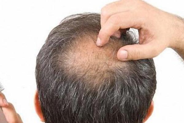 植發(fā)要多少錢一般 植發(fā)可以維持多久 植發(fā)要多少錢一般 植發(fā)可以維持多久