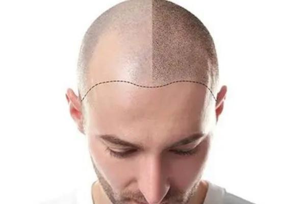 植發(fā)可以用別人的毛囊嗎 植發(fā)可以保持多久時間 植發(fā)可以用別人的毛囊嗎 植發(fā)可以保持多久時間