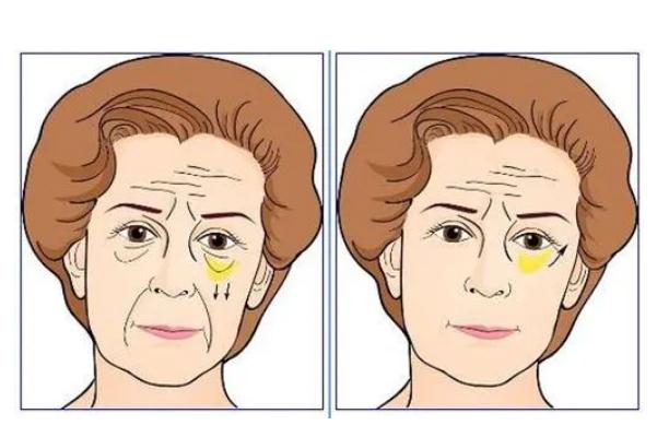 眼袋可以切幾次 眼袋可以通過手術(shù)徹底消除嗎 眼袋可以切幾次 眼袋可以通過手術(shù)徹底消除嗎