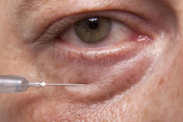 眼袋會不會遺傳 眼袋能自然消除嗎 眼袋會不會遺傳 眼袋能自然消除嗎