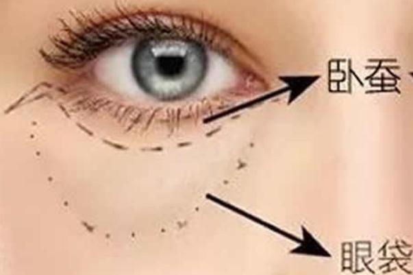 眼袋是脾虛引起的嗎 眼袋是哪個(gè)經(jīng)絡(luò)堵塞 眼袋是脾虛引起的嗎 眼袋是哪個(gè)經(jīng)絡(luò)堵塞