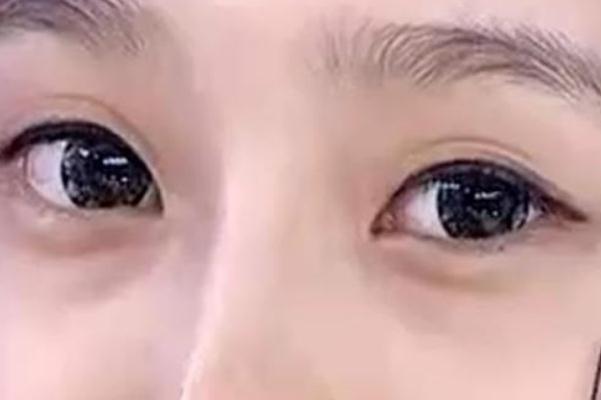 眼袋是脾虛引起的嗎 眼袋是哪個(gè)經(jīng)絡(luò)堵塞 眼袋是脾虛引起的嗎 眼袋是哪個(gè)經(jīng)絡(luò)堵塞