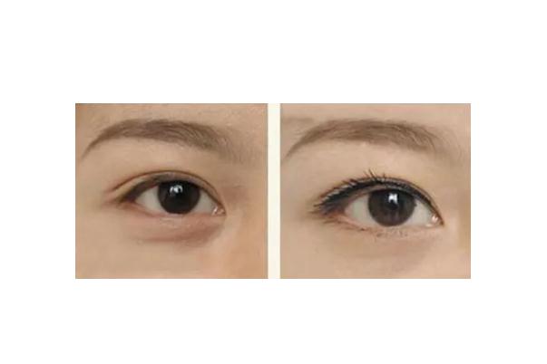 眼袋有細紋了怎么消除 眼袋上有細紋怎么解決 眼袋有細紋了怎么消除 眼袋上有細紋怎么解決