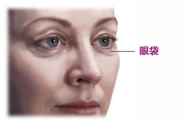 眼袋能熱敷嗎 眼袋是熱敷還是冷敷 眼袋能熱敷嗎 眼袋是熱敷還是冷敷