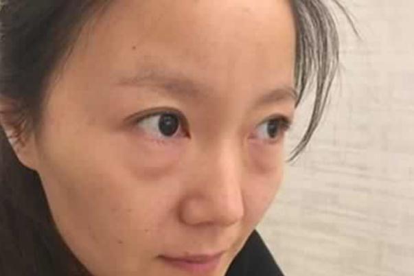 眼袋可以針灸治療嗎 眼袋可以按摩去除嗎 眼袋可以針灸治療嗎 眼袋可以按摩去除嗎