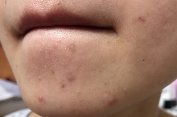 粉刺是痤瘡嗎 粉刺是螨蟲造成的嗎 粉刺是痤瘡嗎 粉刺是螨蟲造成的嗎