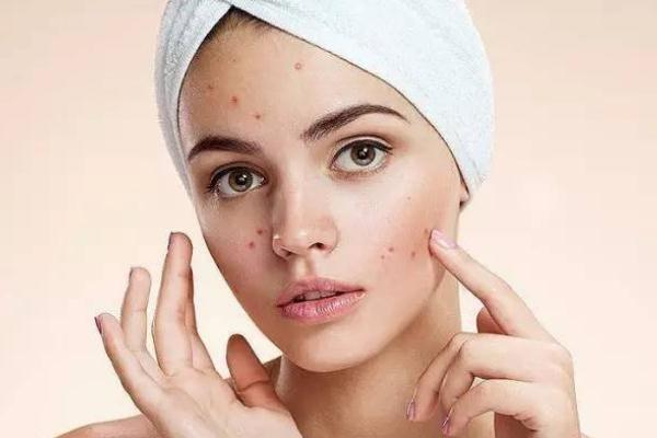 粉刺會(huì)留下痘印么 粉刺會(huì)長(zhǎng)在哪些地方 粉刺會(huì)留下痘印么 粉刺會(huì)長(zhǎng)在哪些地方