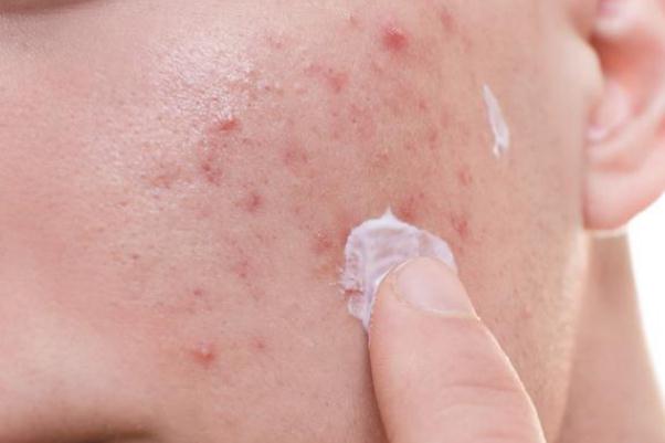 粉刺有膿包怎么處理 粉刺有白色的膿要不要擠掉 粉刺有膿包怎么處理 粉刺有白色的膿要不要擠掉