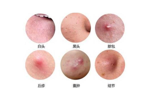 粉刺是什么原因長(zhǎng)出來的 粉刺怎么可以有效的去除