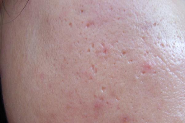 粉刺的正確處理方法 粉刺的白色東西是什么 粉刺的正確處理方法 粉刺的白色東西是什么