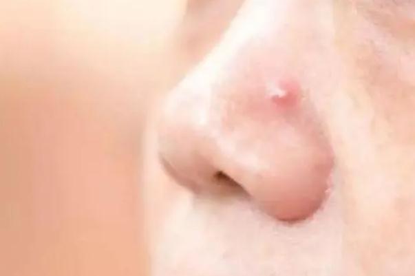 粉刺會(huì)留下痘印么 粉刺會(huì)長(zhǎng)在哪些地方 粉刺會(huì)留下痘印么 粉刺會(huì)長(zhǎng)在哪些地方