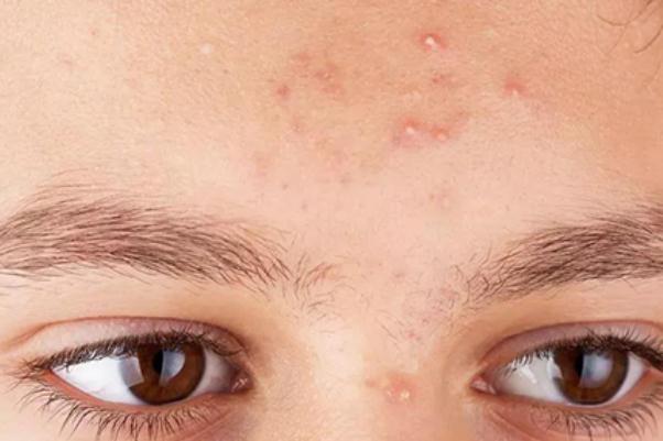 粉刺對身體有什么影響 擠黑頭粉刺會對皮膚有哪些影響 粉刺對身體有什么影響 擠黑頭粉刺會對皮膚有哪些影響