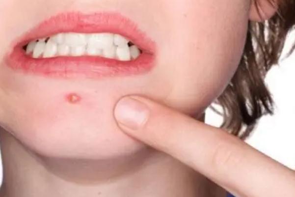 粉刺會(huì)留下痘印么 粉刺會(huì)長(zhǎng)在哪些地方 粉刺會(huì)留下痘印么 粉刺會(huì)長(zhǎng)在哪些地方