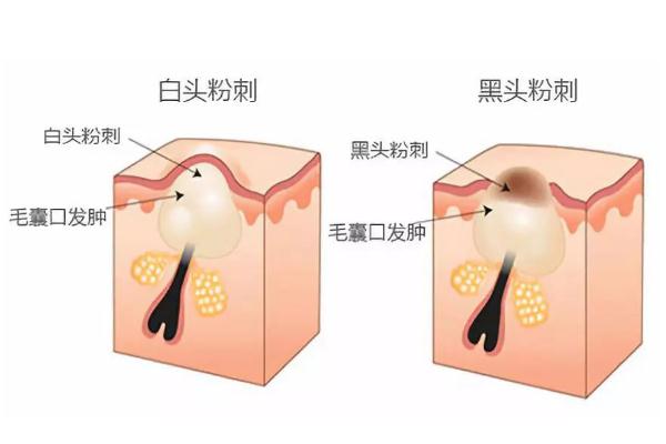 粉刺的正確處理方法 粉刺的白色東西是什么 粉刺的正確處理方法 粉刺的白色東西是什么