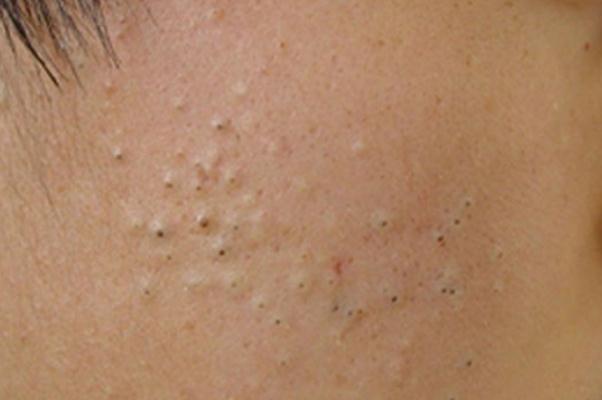 粉刺的正確處理方法 粉刺的白色東西是什么 粉刺的正確處理方法 粉刺的白色東西是什么