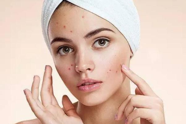 粉刺有硬塊但是擠不出來怎么辦 粉刺會(huì)傳染給別人嗎 粉刺有硬塊但是擠不出來怎么辦 粉刺會(huì)傳染給別人嗎