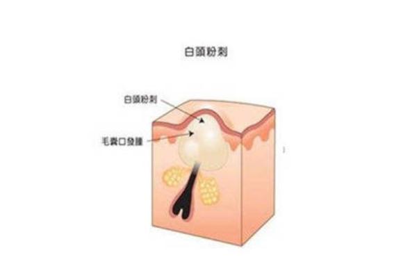 粉刺對身體有什么影響 擠黑頭粉刺會對皮膚有哪些影響 粉刺對身體有什么影響 擠黑頭粉刺會對皮膚有哪些影響