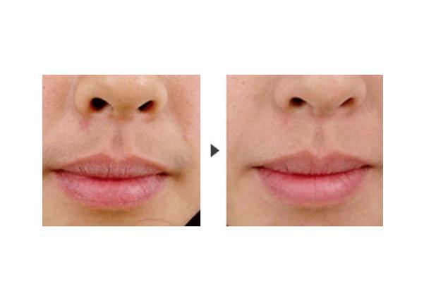 唇毛會(huì)自己慢慢消失嗎 唇毛會(huì)自己脫落嗎 唇毛會(huì)自己慢慢消失嗎 唇毛會(huì)自己脫落嗎