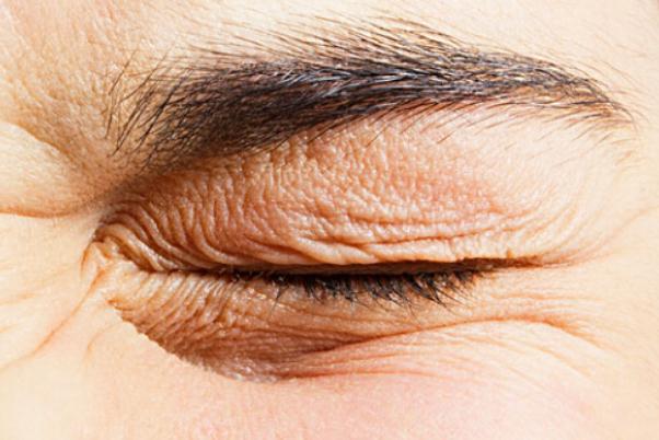 眼部細(xì)紋可以熱敷嗎 眼部細(xì)紋能淡化嗎 眼部細(xì)紋可以熱敷嗎 眼部細(xì)紋能淡化嗎