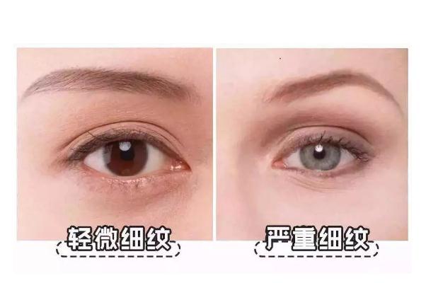 細(xì)紋是怎么產(chǎn)生的 細(xì)紋干紋怎么消除 細(xì)紋是怎么產(chǎn)生的 細(xì)紋干紋怎么消除