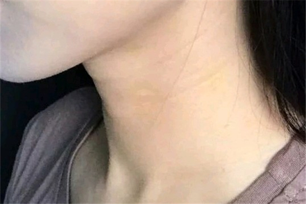 頸紋和胖瘦有關(guān)系嗎 頸紋是因?yàn)榕植庞械膯? alt=