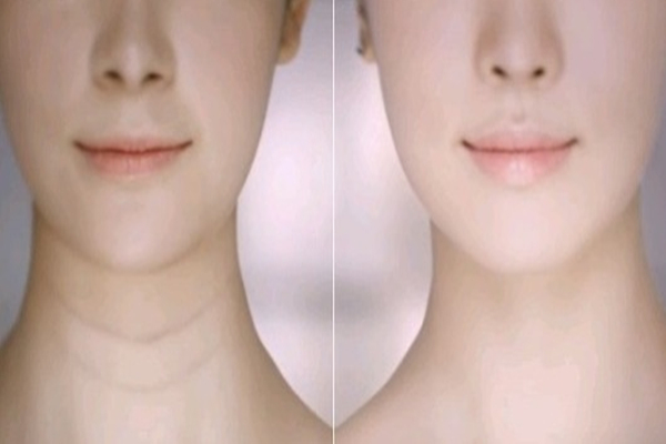 頸紋可以永久去除嗎 頸紋可以打玻尿酸嗎 頸紋可以永久去除嗎 頸紋可以打玻尿酸嗎