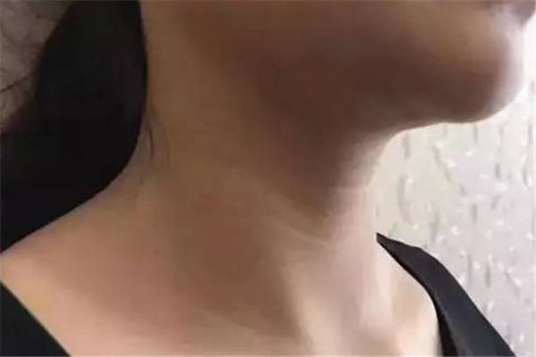 頸紋去除術(shù)可以維持多久 頸紋去除術(shù)是永久的嗎 頸紋去除術(shù)可以維持多久 頸紋去除術(shù)是永久的嗎