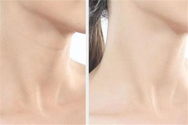 頸紋和胖瘦有關(guān)系嗎 頸紋是因?yàn)榕植庞械膯? alt=