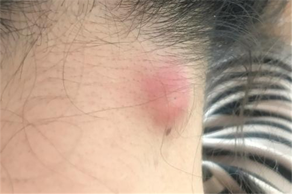 火癤子怎么治療最快 火癤子是什么引起的 火癤子怎么治療最快 火癤子是什么引起的