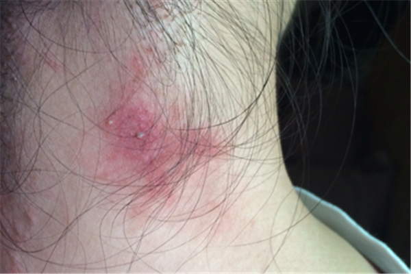 火癤子會(huì)復(fù)發(fā)嗎 火癤子為什么反復(fù)長 火癤子會(huì)復(fù)發(fā)嗎 火癤子為什么反復(fù)長