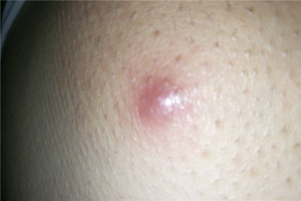 火癤子會自愈嗎 火癤子長什么樣 火癤子會自愈嗎 火癤子長什么樣