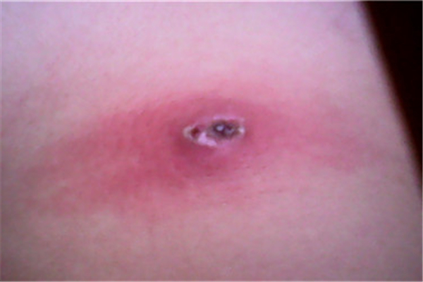 火癤子會自愈嗎 火癤子長什么樣 火癤子會自愈嗎 火癤子長什么樣