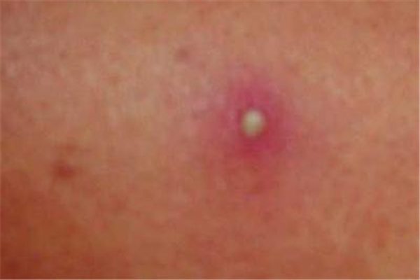 火癤子長屁股上怎么辦 火癤子哪里都長嗎 火癤子長屁股上怎么辦 火癤子哪里都長嗎