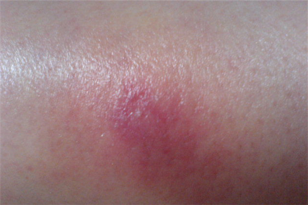 火癤子會(huì)復(fù)發(fā)嗎 火癤子為什么反復(fù)長 火癤子會(huì)復(fù)發(fā)嗎 火癤子為什么反復(fù)長