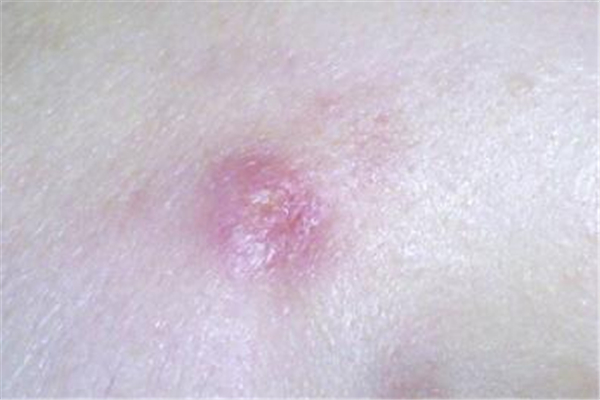 火癤子有了白點(diǎn)可以擠破嗎 火癤子可以刺破嗎 火癤子有了白點(diǎn)可以擠破嗎 火癤子可以刺破嗎